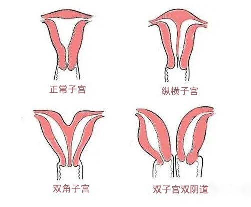 子宫是畸形是什么意思