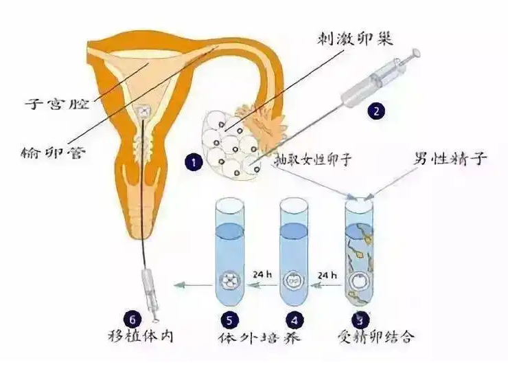 人工取卵是什么意思