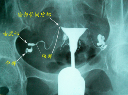 试管双胞胎需要什么条件