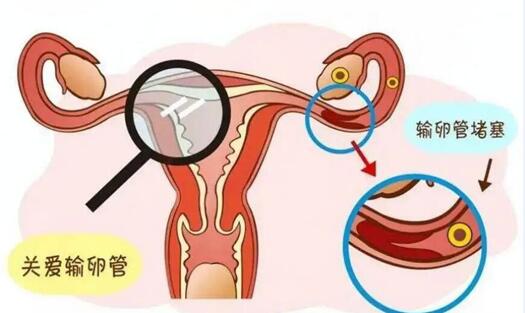 怎么证明输卵管是通的?附输卵管自测9种方法分别是什么？