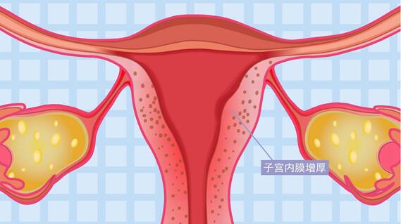 子宫内膜厚18mm需要刮宫吗？宫内膜厚18mm不治疗可以吗？