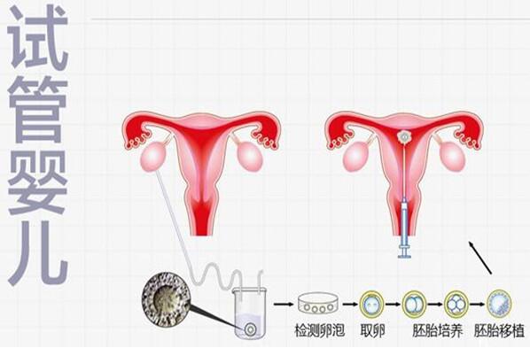 双侧输精管缺如做试管成功率到底高不高?