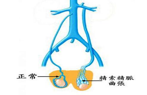 双侧精索静脉曲张有什么危害?影响怀孕吗?