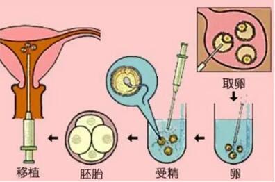 试管婴儿的历史