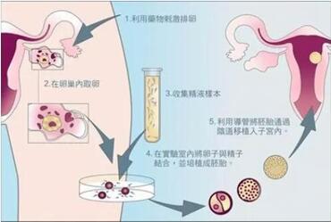 试管婴儿过程