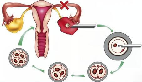 试管婴儿怎么取卵