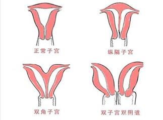 哪一种子宫畸形最严重?子宫畸形是怎么造成的?