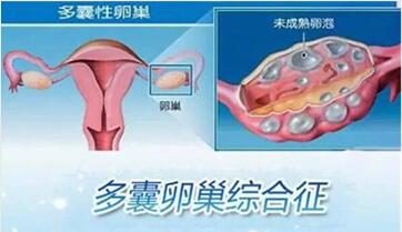 多囊卵巢可以怀上孩子吗?多囊卵巢做试管婴儿成功率高吗?