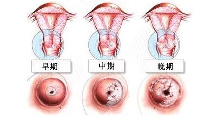 宫颈糜烂一二三度症状有哪些?三种常见的治疗方法!
