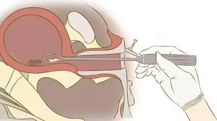 子宫内膜基底层损伤还能不能做试管?看看医生怎么说!