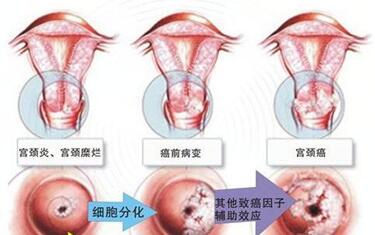 宫颈炎对女性的危害都有些什么呢?女性宫颈炎的五大危害要重视!