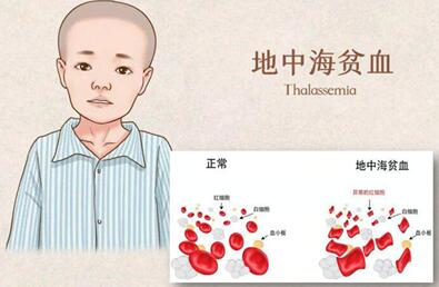 地中海贫血能生出健康的小孩吗?但是需要在生育之前做好检查!