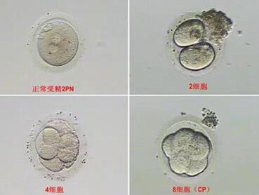 2pn胚胎成功率高吗?试管1pn和2pn哪个好?