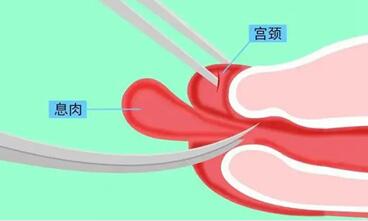 宫颈息肉一厘米需要动手术吗?宫颈息肉有什么危害吗