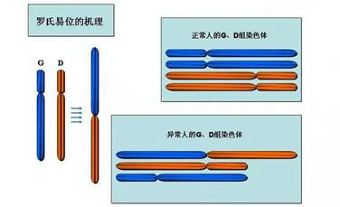 解读染色体罗氏易位检测:家长需要做三代试管及羊水穿刺