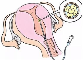 试管婴儿取卵后多久移植成功率高点?如何提高试管婴儿移植成功率