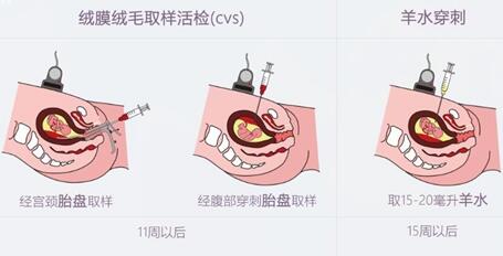 绒毛穿刺是检查什么的?绒毛穿刺流程是怎么做的