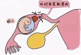 宫外孕手术风险大吗?宫外孕手术后需要多久恢复