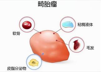 畸胎瘤是不是胎儿死在肚子里了?如何治疗畸胎瘤