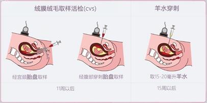 绒毛穿刺检查哪些染色体异常?医疗科普