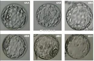 囊胚4AA是什么级别?试管囊胚4aa会出现胎停育吗